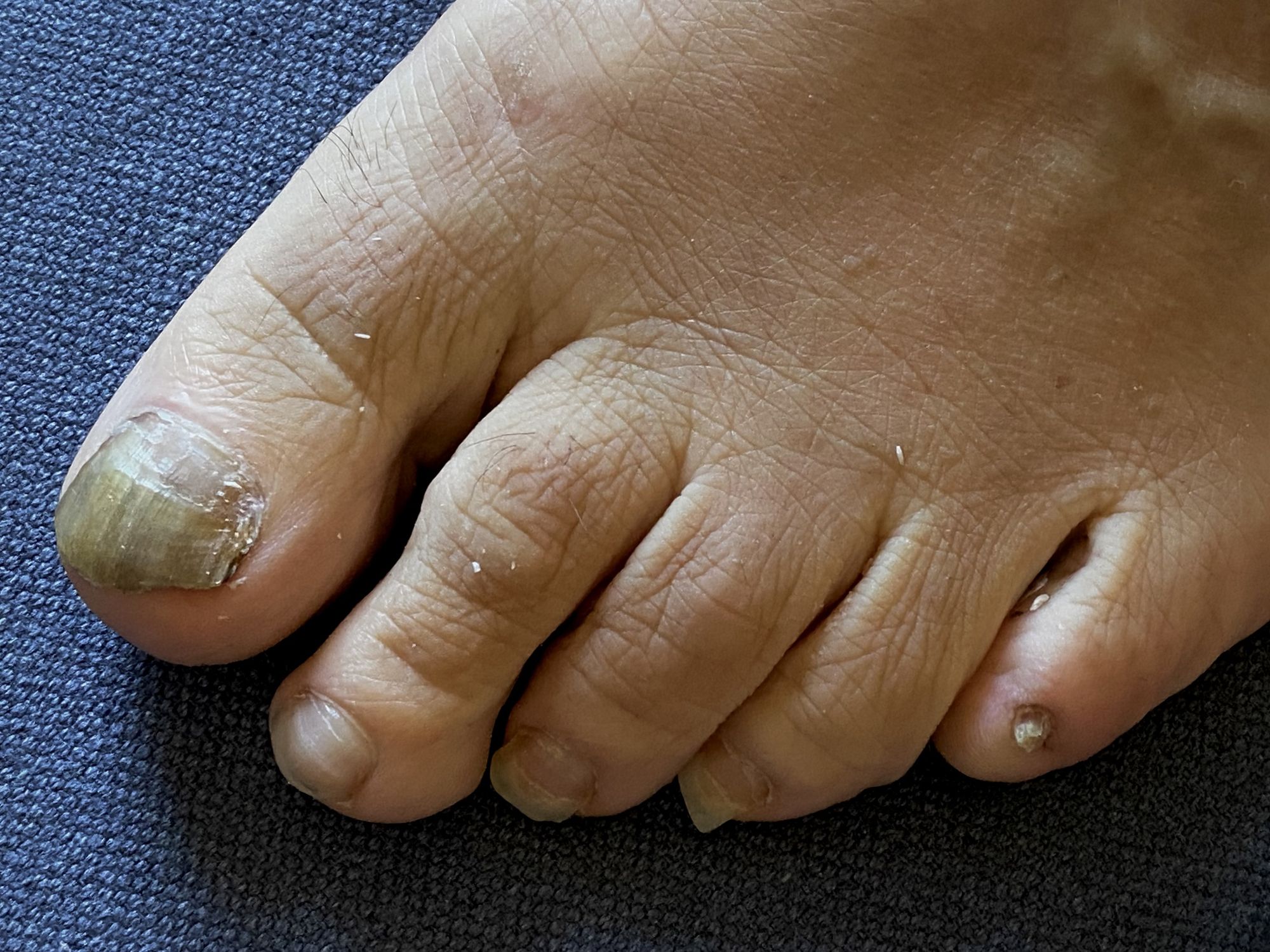 Cómo eliminar hongos en las uñas de los pies rápidamente